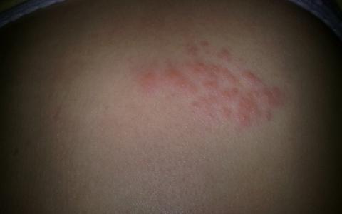 Štípance na chrbte